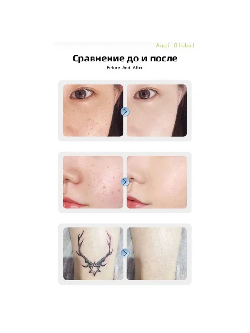 Электрическая ручка для удаления родинок и пятен лазерная, вариант, фото 5