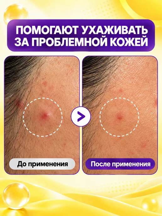 Гидроколлоидные патчи от прыщей, 324 шт, 324 шт, фото 3